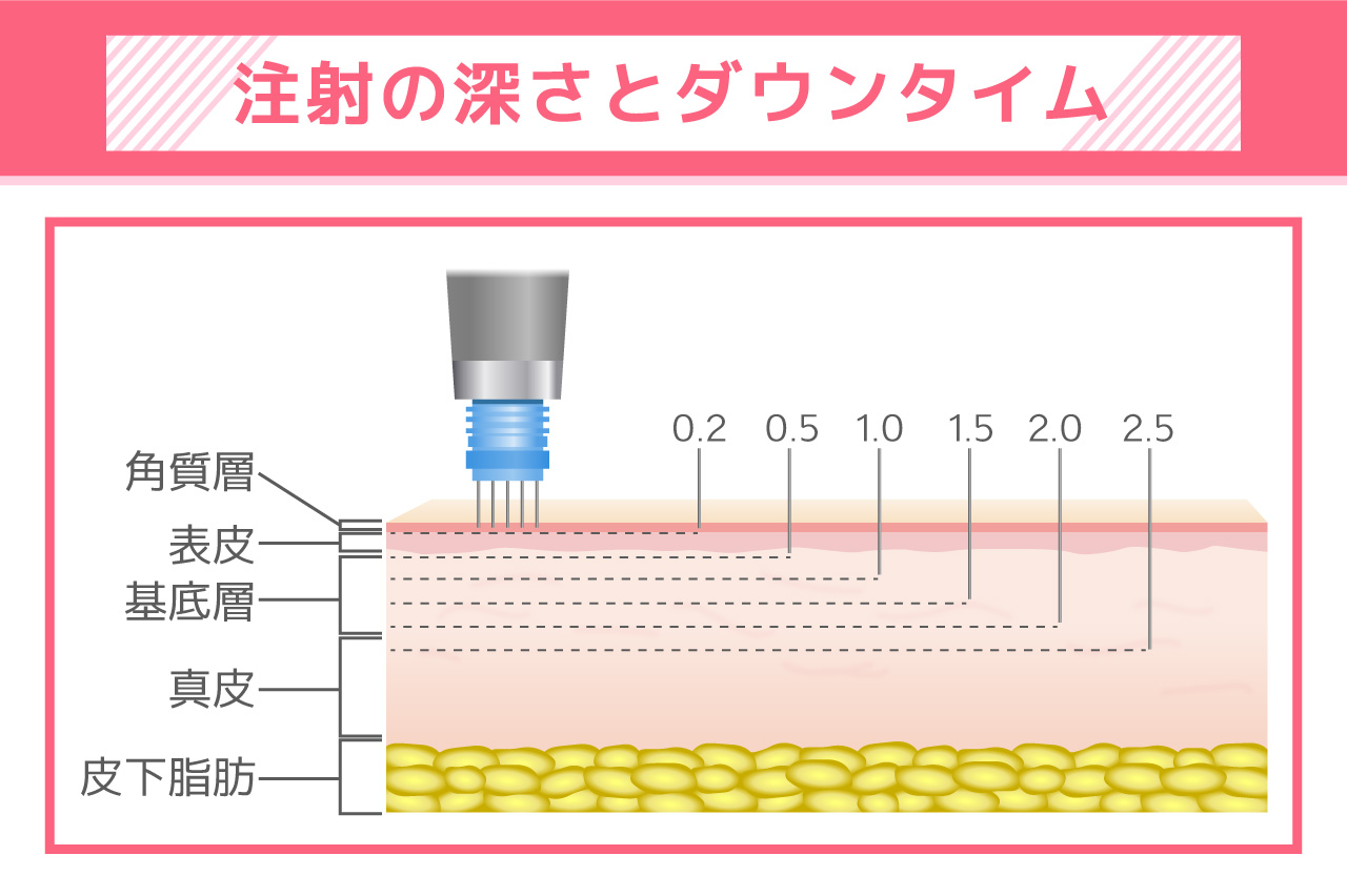 SBCダーマペンの注射の深さとダウンタイム